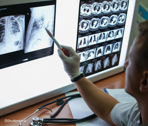 Chest x-rays 