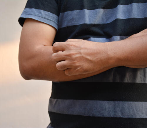 Man itching his arm