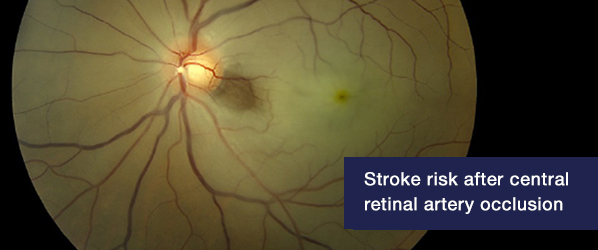 Stroke risk after central retinal artery occlusion