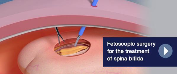 Fetoscopic surgery for the treatment of spina bifida